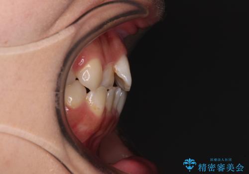 【モニター】短期間で終わりたい ワイヤー装置での非抜歯矯正の治療前