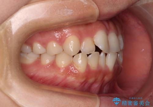 【モニター】短期間で終わりたい ワイヤー装置での非抜歯矯正の治療前