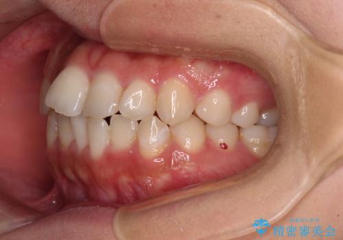 【モニター】短期間で終わりたい ワイヤー装置での非抜歯矯正の治療前