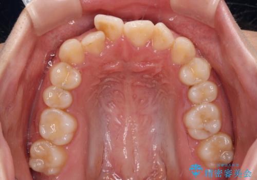 【モニター】短期間で終わりたい ワイヤー装置での非抜歯矯正の治療前