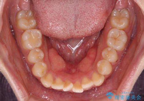 【モニター】短期間で終わりたい ワイヤー装置での非抜歯矯正の治療前