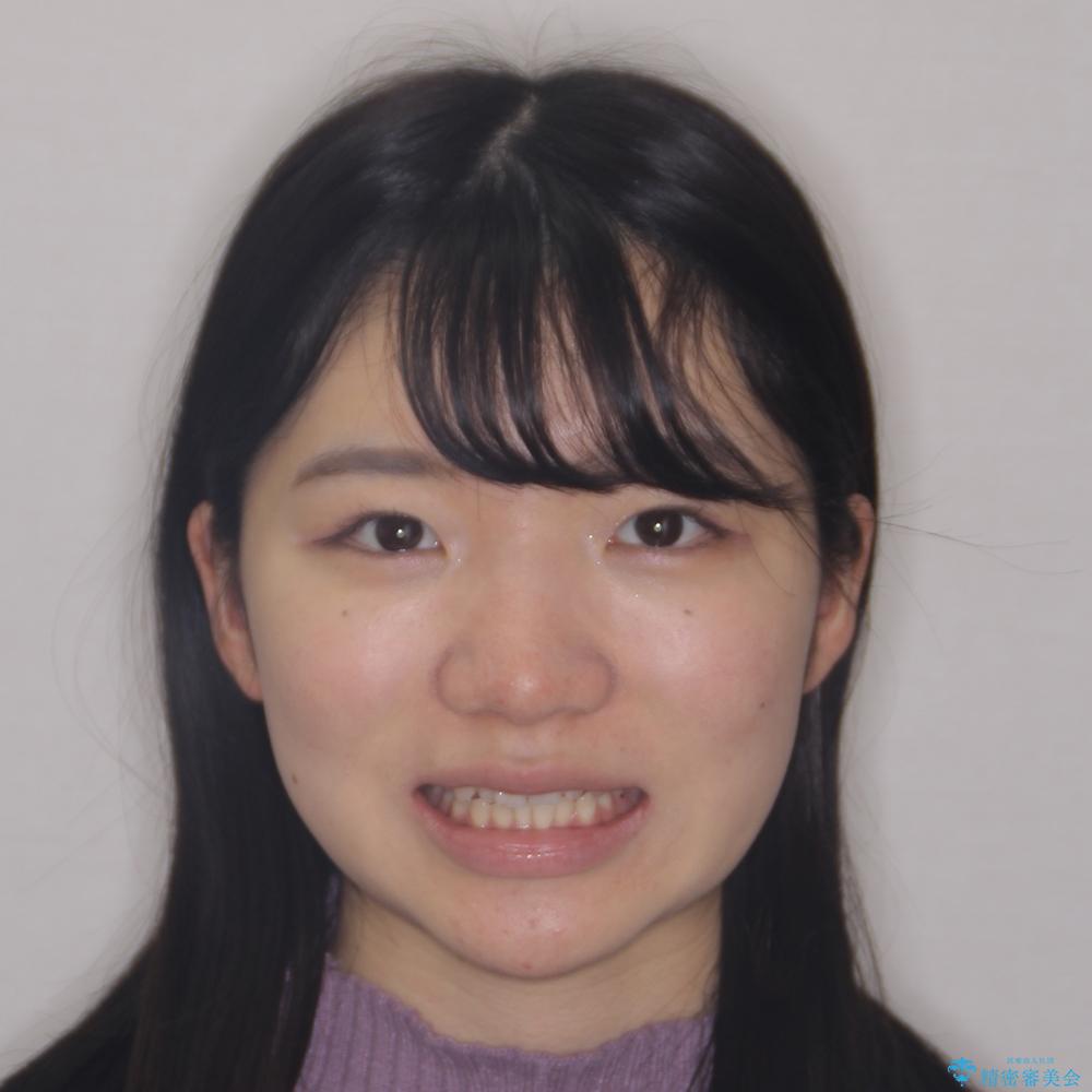 【モニター】短期間で終わりたい ワイヤー装置での非抜歯矯正の治療前(顔貌)