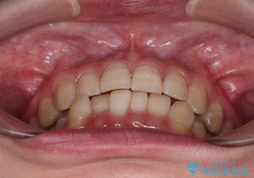 【モニター】下顎前歯のデコボコをインビザラインできれいにの治療前