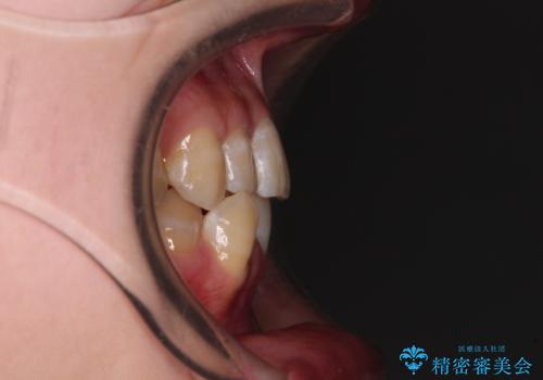 【モニター】下顎前歯のデコボコをインビザラインできれいにの治療前