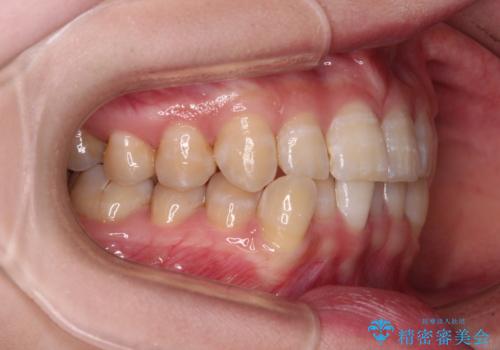 【モニター】下顎前歯のデコボコをインビザラインできれいにの治療前