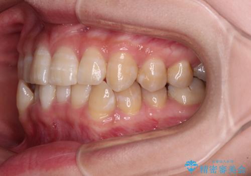 【モニター】下顎前歯のデコボコをインビザラインできれいにの治療前