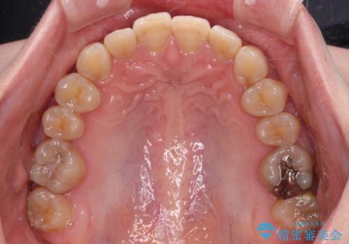【モニター】下顎前歯のデコボコをインビザラインできれいにの治療前