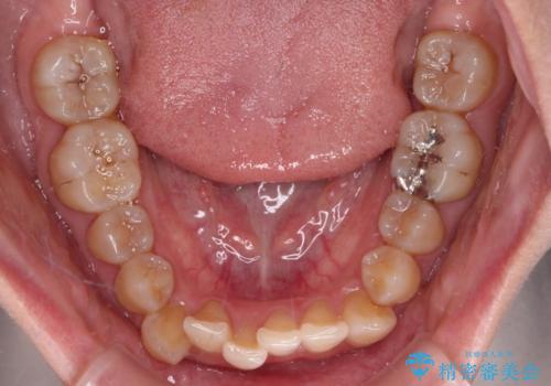 【モニター】下顎前歯のデコボコをインビザラインできれいにの治療前