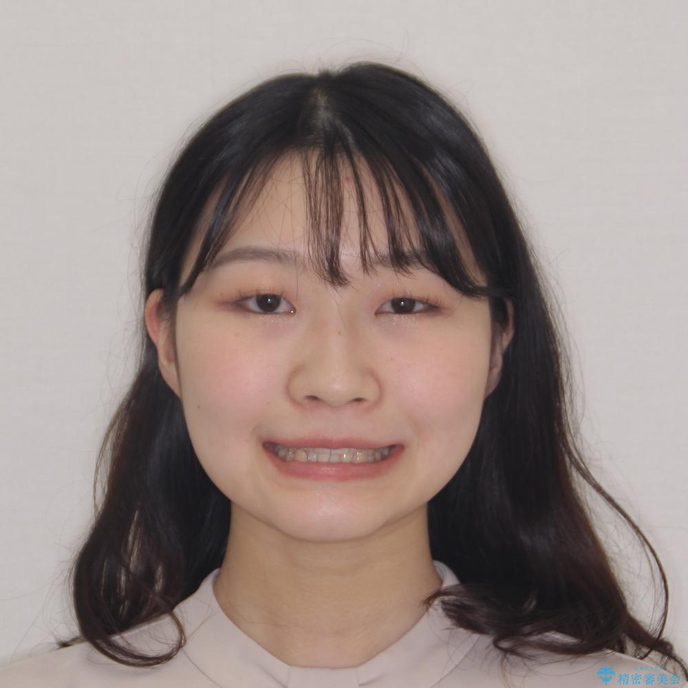 【モニター】下顎前歯のデコボコをインビザラインできれいにの治療前(顔貌)