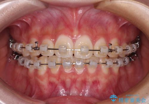 インビザラインは使える自信がない ワイヤー装置にて矯正治療の治療中