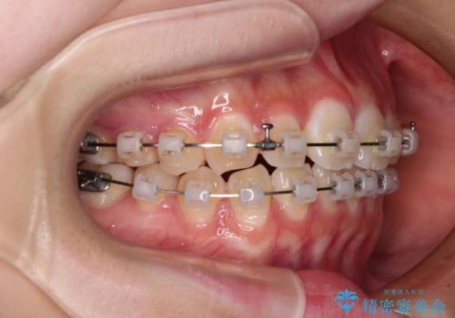 インビザラインは使える自信がない ワイヤー装置にて矯正治療の治療中