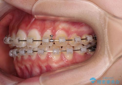 インビザラインは使える自信がない ワイヤー装置にて矯正治療の治療中