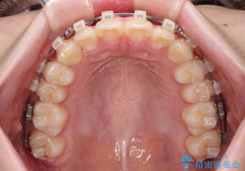 インビザラインは使える自信がない ワイヤー装置にて矯正治療の治療中