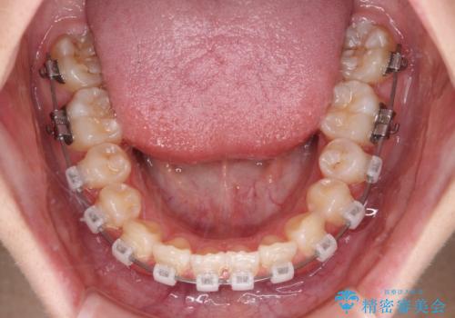 インビザラインは使える自信がない ワイヤー装置にて矯正治療の治療中