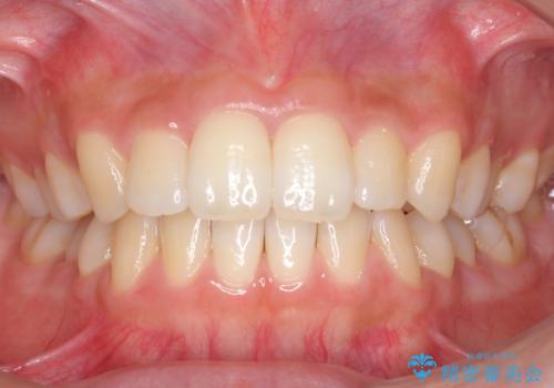 歯を抜かない矯正 出っ歯を抜かずに大きく下げることは可能です。の症例 治療前