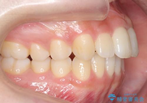 歯を抜かない矯正 出っ歯を抜かずに大きく下げることは可能です。の治療前