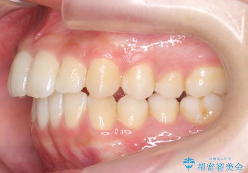 歯を抜かない矯正 出っ歯を抜かずに大きく下げることは可能です。の治療前