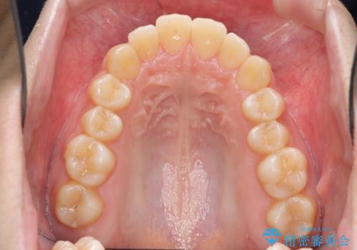 歯を抜かない矯正　出っ歯を抜かずに大きく下げることは可能です。の治療前
