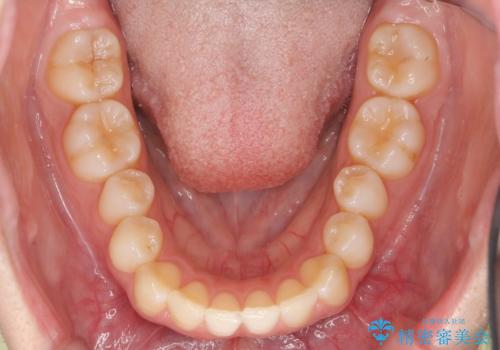歯を抜かない矯正 出っ歯を抜かずに大きく下げることは可能です。の治療前