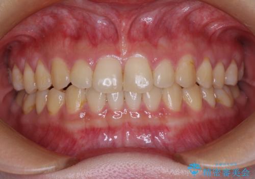 治療途中の奥歯と矯正治療の後戻り インビザライン・ライトによる矯正治療の治療中