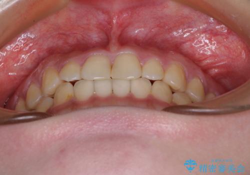 治療途中の奥歯と矯正治療の後戻り インビザライン・ライトによる矯正治療の治療中