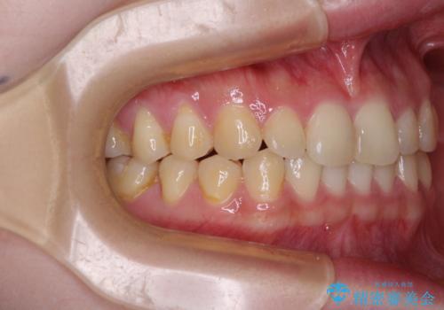 治療途中の奥歯と矯正治療の後戻り インビザライン・ライトによる矯正治療の治療中