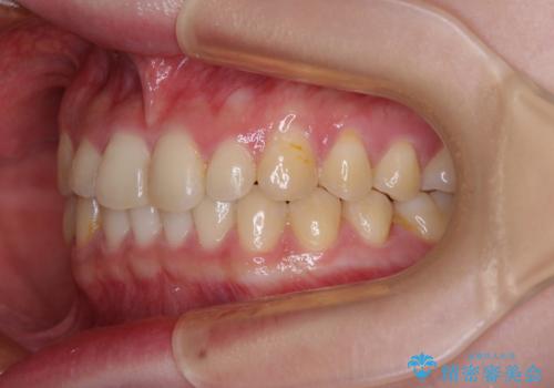 治療途中の奥歯と矯正治療の後戻り インビザライン・ライトによる矯正治療の治療中