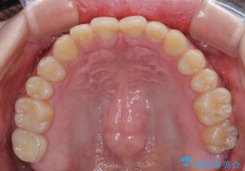 治療途中の奥歯と矯正治療の後戻り インビザライン・ライトによる矯正治療の治療中