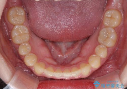 治療途中の奥歯と矯正治療の後戻り インビザライン・ライトによる矯正治療の治療中