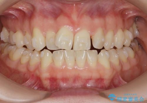 前歯の目立つガタつきをマウスピース矯正で治療の治療中