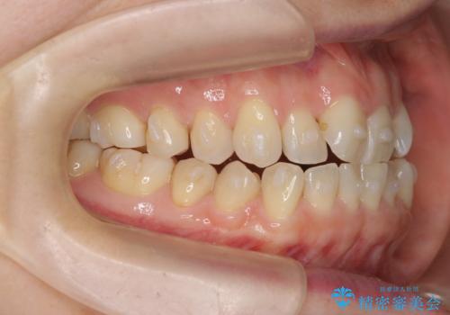 前歯の目立つガタつきをマウスピース矯正で治療の治療中