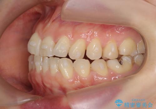 前歯の目立つガタつきをマウスピース矯正で治療の治療中