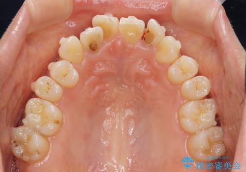 前歯の目立つガタつきをマウスピース矯正で治療の治療中