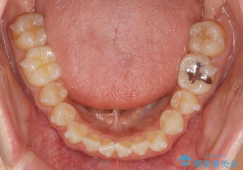 前歯の目立つガタつきをマウスピース矯正で治療の治療中