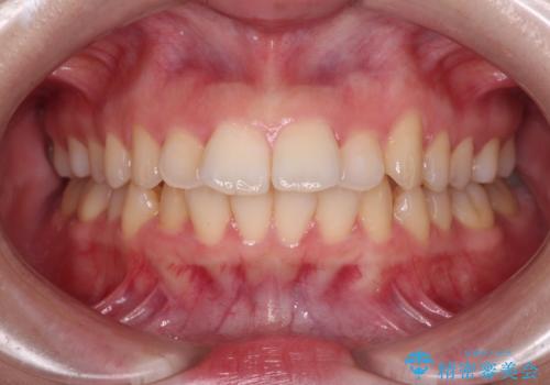 口が閉じられない　ワイヤー装置での抜歯矯正の症例 治療前