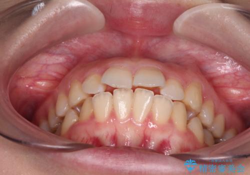 口が閉じられない ワイヤー装置での抜歯矯正の治療前