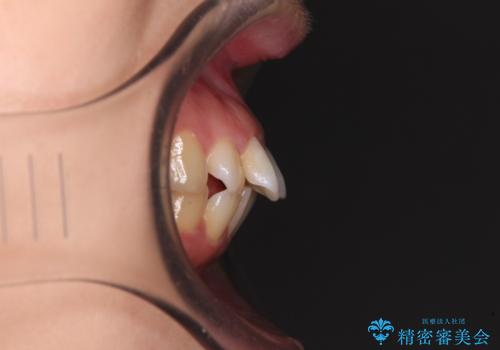 口が閉じられない　ワイヤー装置での抜歯矯正の治療前