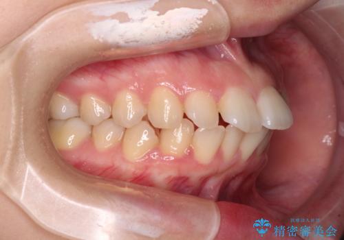 口が閉じられない ワイヤー装置での抜歯矯正の治療前