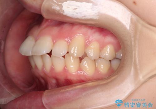 口が閉じられない ワイヤー装置での抜歯矯正の治療前