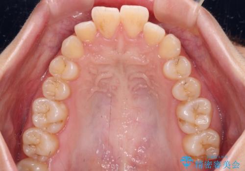 口が閉じられない ワイヤー装置での抜歯矯正の治療前