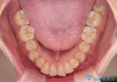口が閉じられない　ワイヤー装置での抜歯矯正の治療前