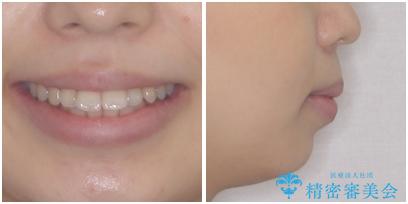 口が閉じられない ワイヤー装置での抜歯矯正の治療前(顔貌)