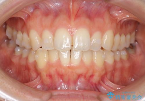 前歯のガタつきをマウスピースで治したい!の治療中