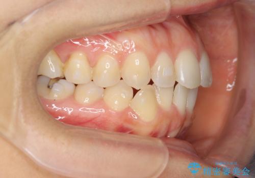 前歯のガタつきをマウスピースで治したい!の治療中