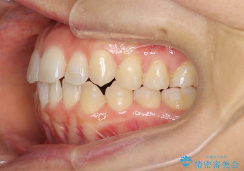 前歯のガタつきをマウスピースで治したい!の治療中