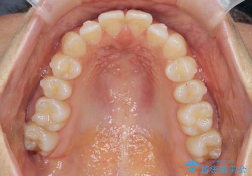 前歯のガタつきをマウスピースで治したい!の治療中
