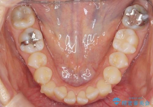 前歯のガタつきをマウスピースで治したい!の治療中
