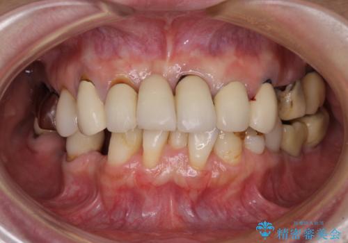 放置したインプラントとインビザライン 全顎リカバリー治療の治療前