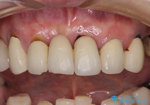 放置したインプラントとインビザライン 全顎リカバリー治療の症例 治療前