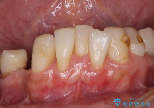 放置したインプラントとインビザライン 全顎リカバリー治療の治療前